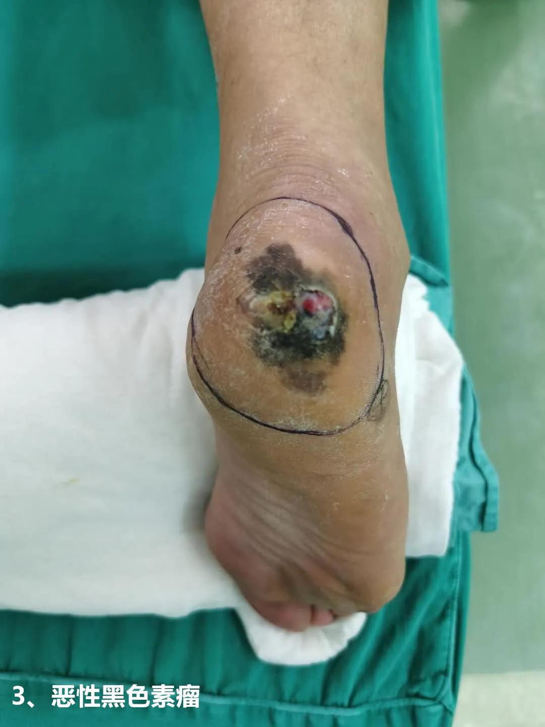 身上有痣到底要不要切除做病理,身上的痣会不会癌变一张图告诉你