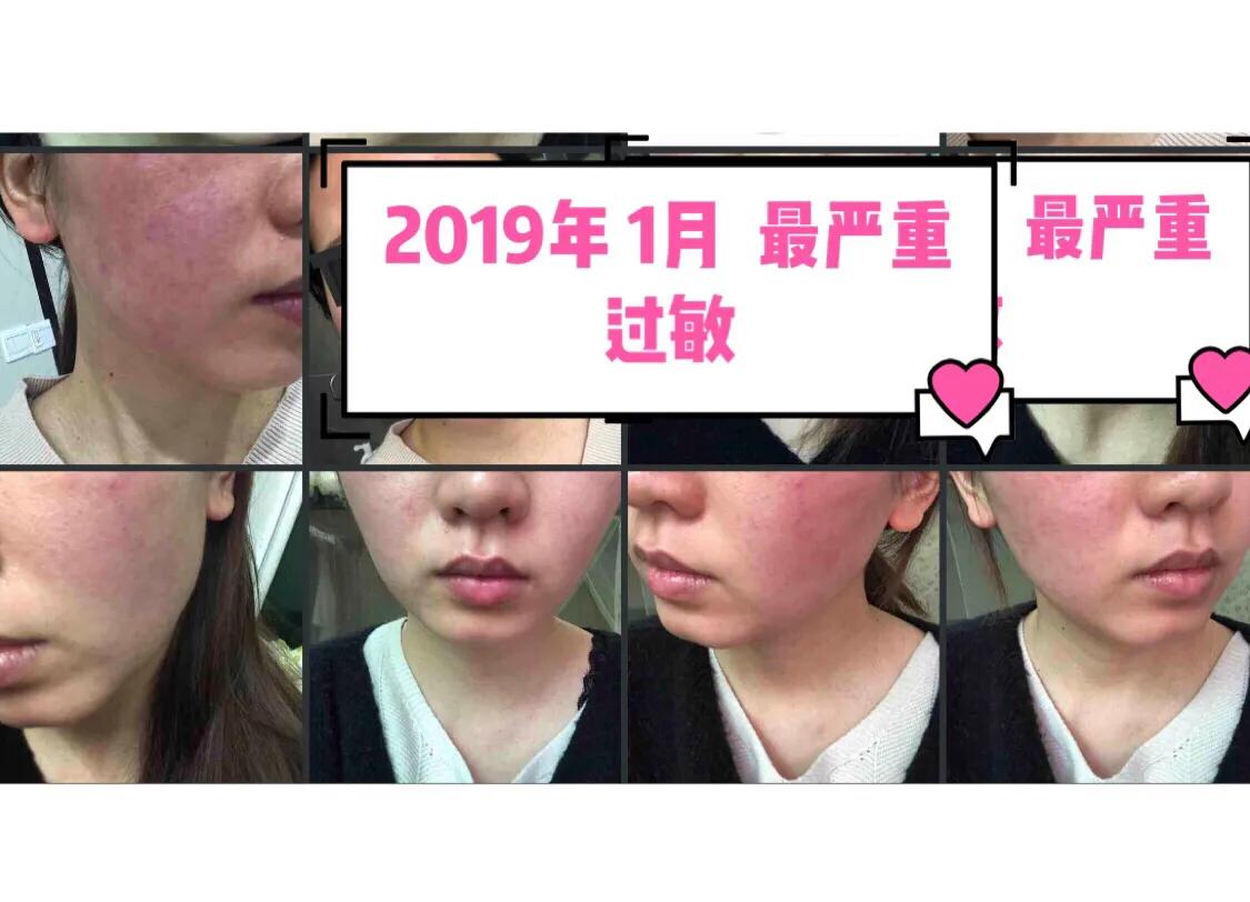 与病魔对抗的第30天,激素脸排毒第31天