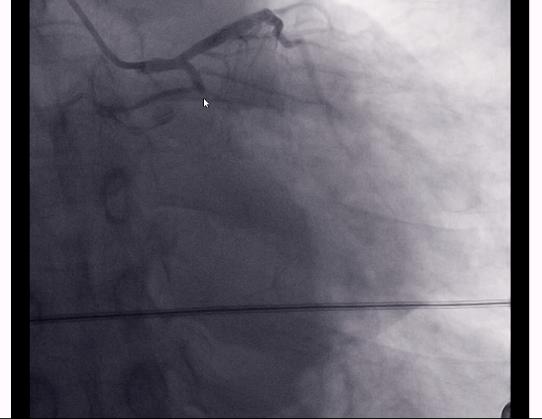 60岁冠心病胸闷气短吃什么药,冠心病患者出现胸闷后怎么处理