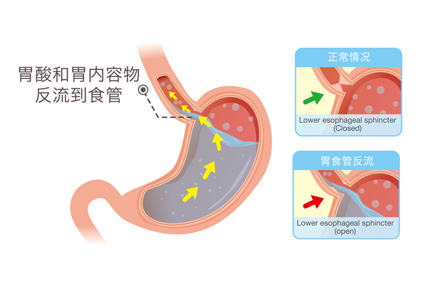 胃食管反流病的胃镜诊断,胃食管反流ph值检测怎么做