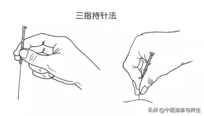 针灸绝技绝招立竿见影,针灸最狠针法
