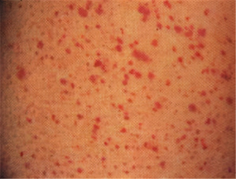 为什么小孩嘴唇周围会出现紫癜,儿童眼周围出现很多小血点紫癜图