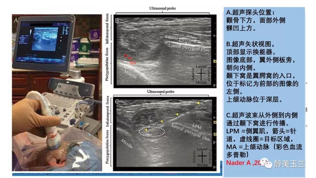 病例分享丨三叉神经节微球囊压迫术的麻醉管理