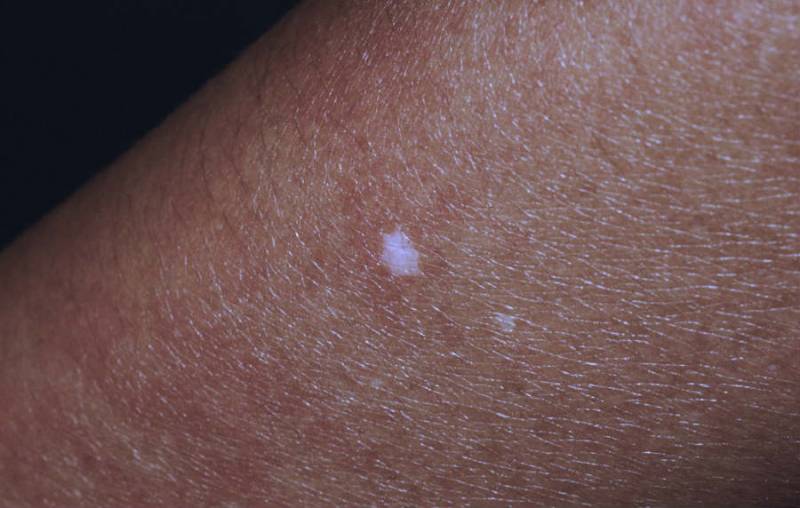 白斑是白癜风吗医生为你详解,得了白癜风感觉身上都是白斑