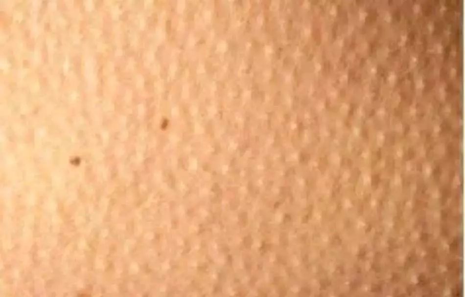 毛囊炎加鸡皮肤怎么根治,鸡皮肤和鱼鳞病怎样根治