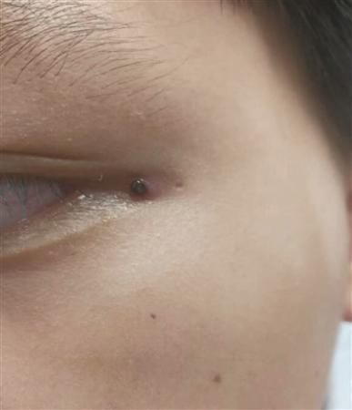 身上有针尖大小黑点,身上出现不明黑点