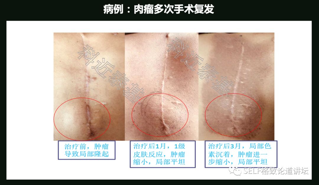 这个装置成功辅助我国两弹爆炸，现在它能治疗肿瘤