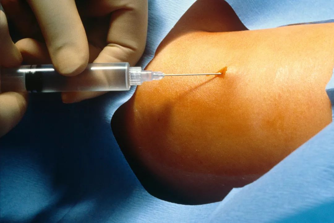 在美国做手术,在美国做什么避孕手术