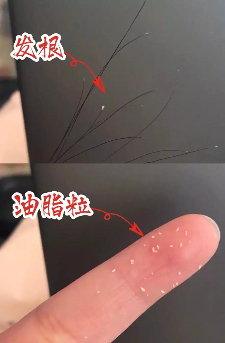 头油头皮屑多脱发洗发水,头油头皮屑多洗发水推荐