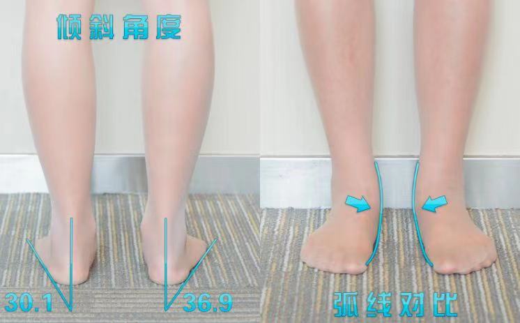 常年膝关节病治疗无果，骨科林医生分析下肢力线施以矫形鞋