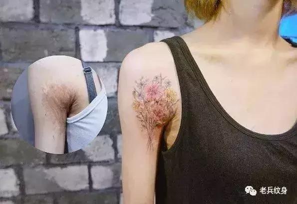 疤痕体质可以用纹身去遮盖疤痕吗,你的疤痕是什么颜色呢