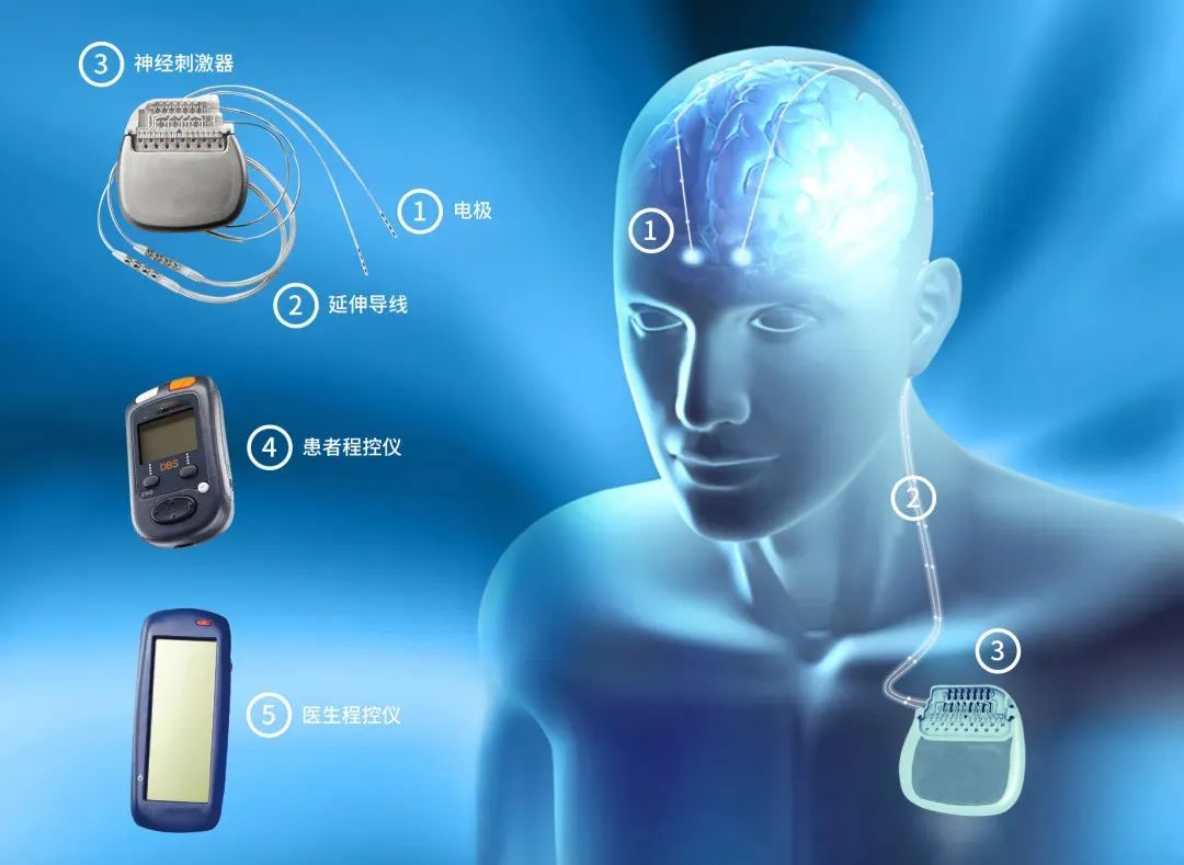 药物失效，肉毒素也失效，该拿什么拯救痉挛性斜颈？