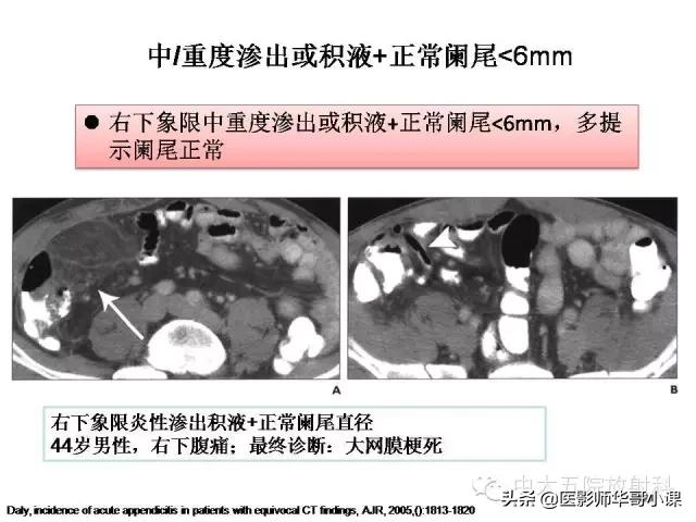 阑尾炎课件,阑尾炎的超声课件