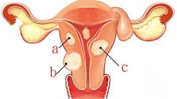 子宫肌瘤手术后一般几年再复发,子宫肌瘤手术后复发中医治疗