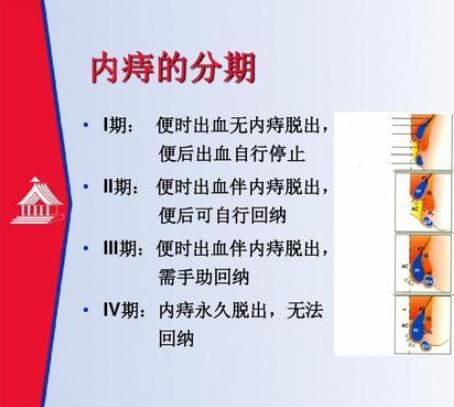 痔疮该怎么治疗？肛肠科朱医生答疑系列之二