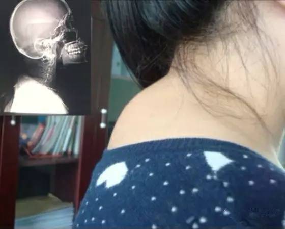 脖子后面颈椎有个鼓包怎么办,颈椎大包怎样通过锻炼来恢复