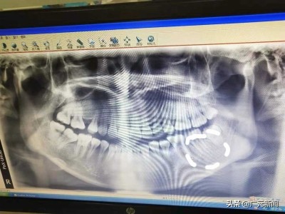 补牙针头断牙腔，诊所称“正常”，可向市卫健委申报进行事故认定，诊所将根据认定结果进行相关处置