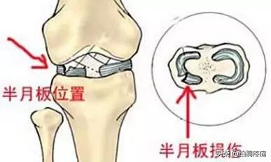 老年人膝盖水肿痛的三大病因,左脚膝盖后面酸痛是什么病因