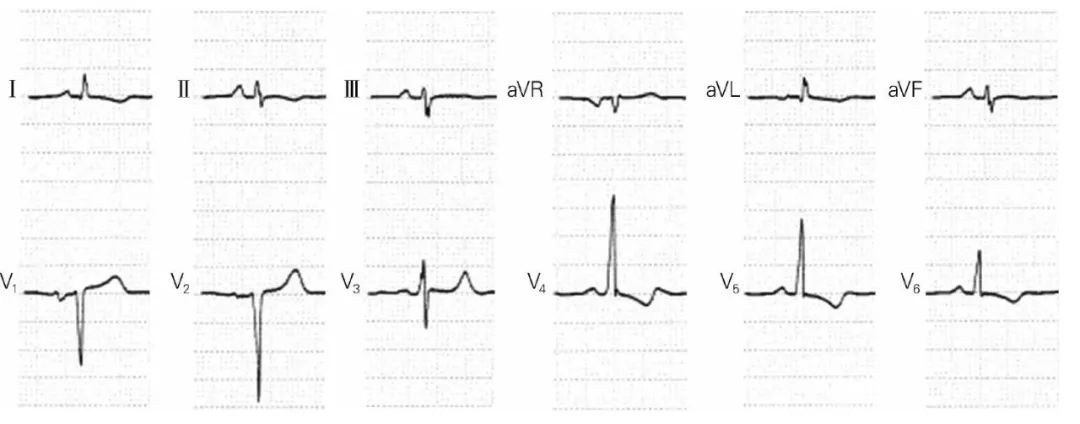 心电图qrs波群是什么意思,心电图中qrs电压怎么看