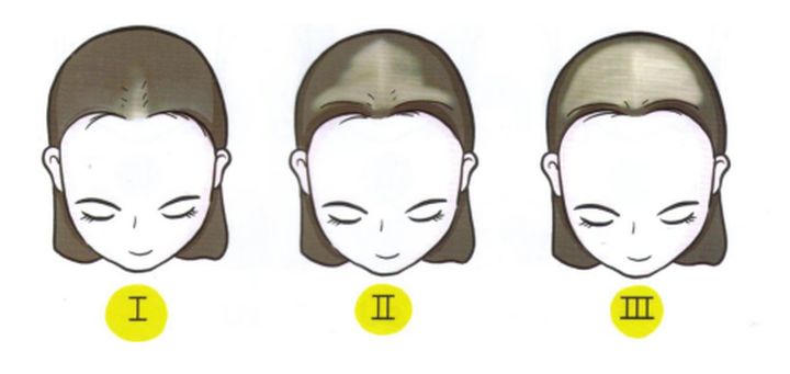 怎样辨别自己脱发,脱发判断最简单的方法