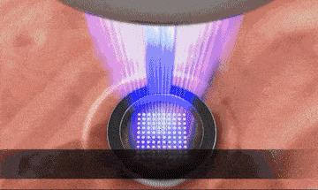 激光美容的12个误区一定要记清,激光美容的正确方法