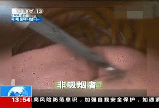 戒烟以后多久肺会恢复变白,吸烟的肺会自然好转吗