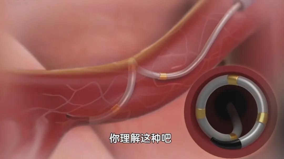 血压高可以根治吗,血压高能彻底治愈吗