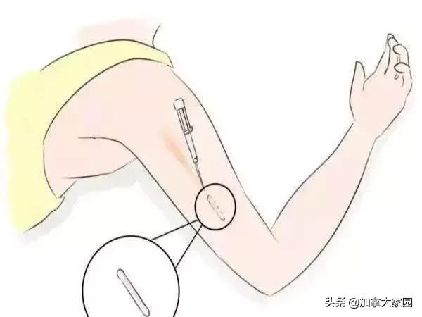 女性避孕贴片新型,美国避孕贴效果怎么样