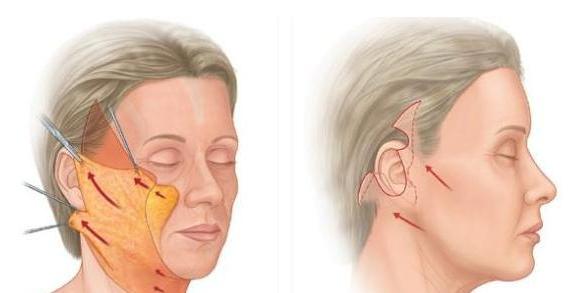 浙江阿姨拉皮手术,经典拉皮手术