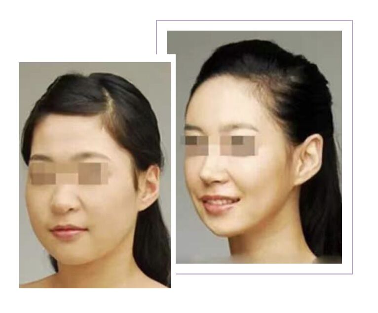 关于瘦脸的知识,关于瘦脸针