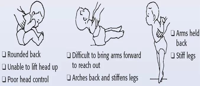 孩子运动发育迟缓怎么办,10个月宝宝运动发育迟缓怎么办