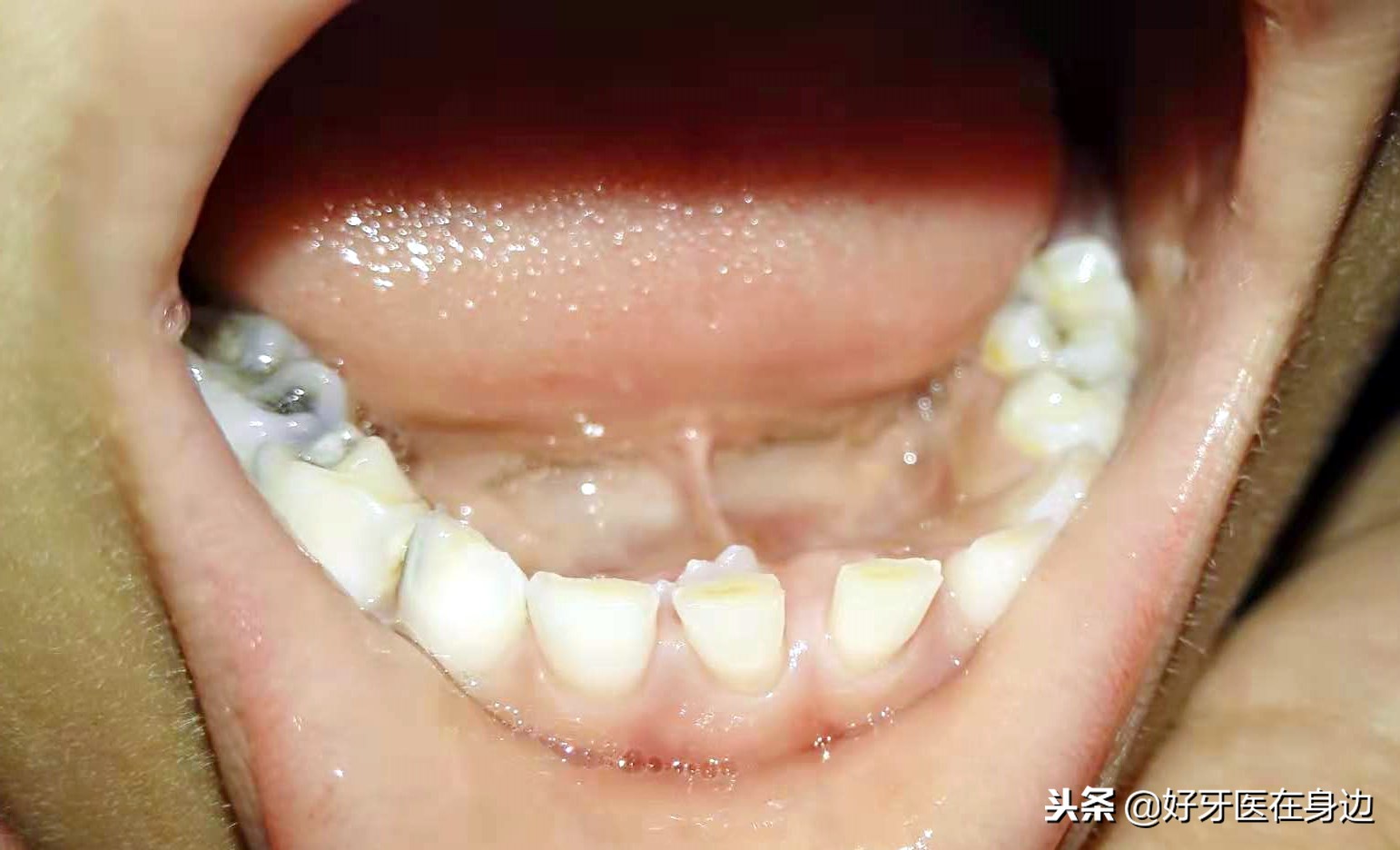 孩子出现双排牙要注意什么,1周岁双排牙怎么处理