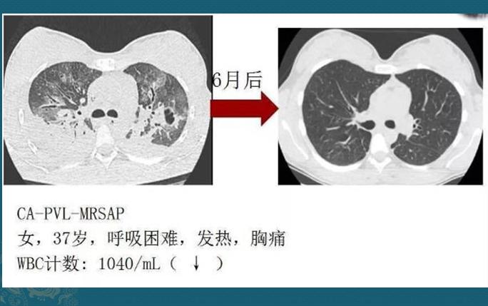化脓性细菌感染用什么抗生素,化脓性细菌感染有痰用什么抗生素