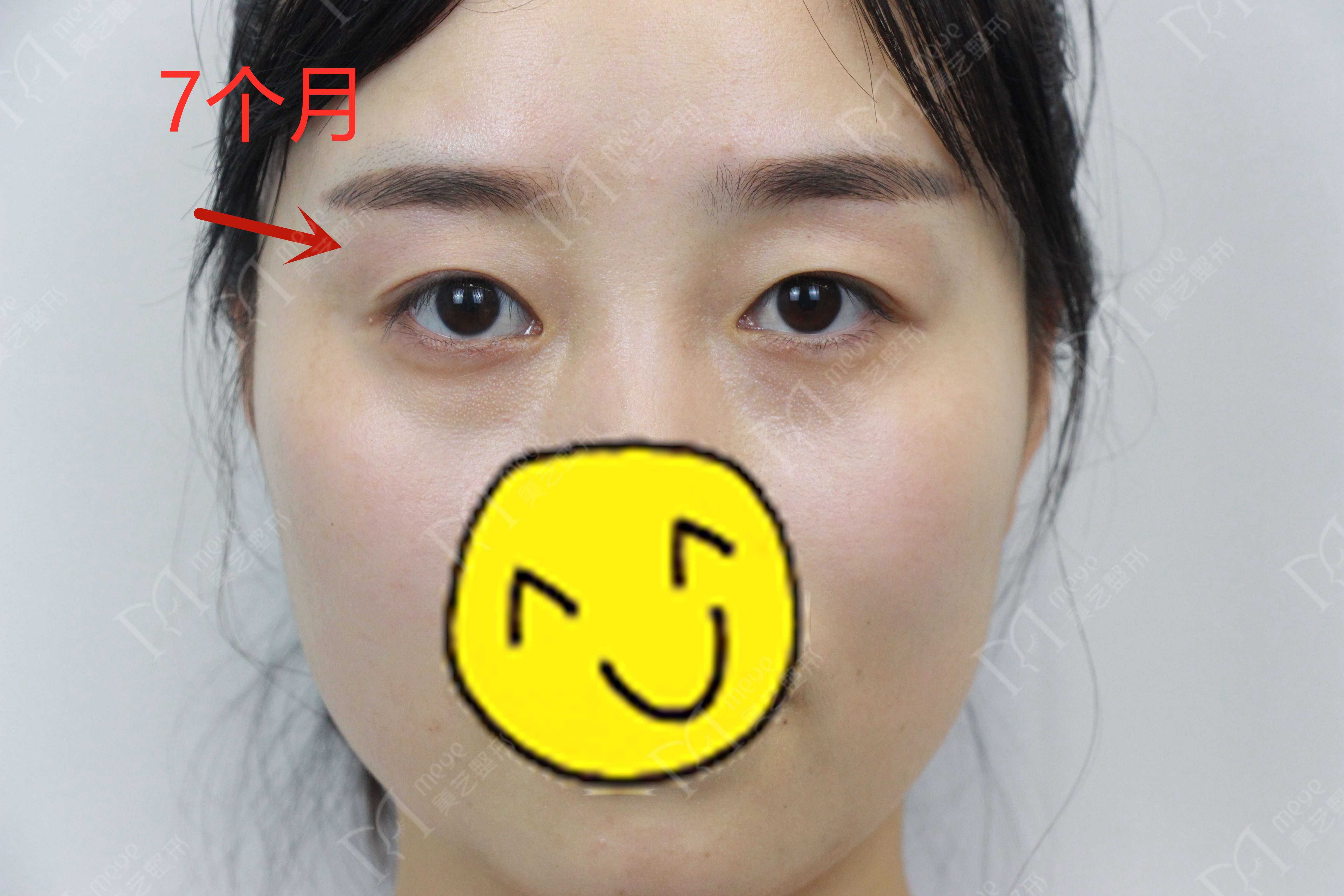 女子双眼皮术后大小眼,大小眼做了双眼皮感觉眼角不对称