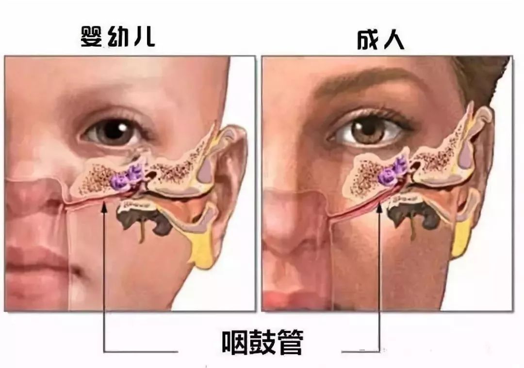 分泌性中耳炎原来是鼻子惹的祸,分泌性中耳炎是治鼻子还是耳朵