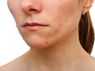 痘痘肌怎么护肤比较好,痘痘肌如何护肤学生