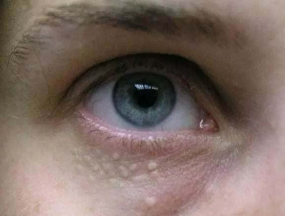 眼睛周围长特别痒小疙瘩怎么回事,女性眼睛周围长疙瘩是什么原因