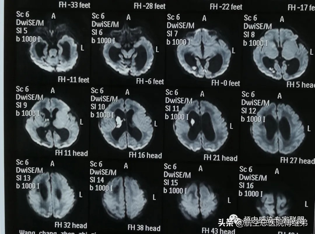 婴儿脑积水治疗方法动画演示,ommaya囊植入术是大手术吗