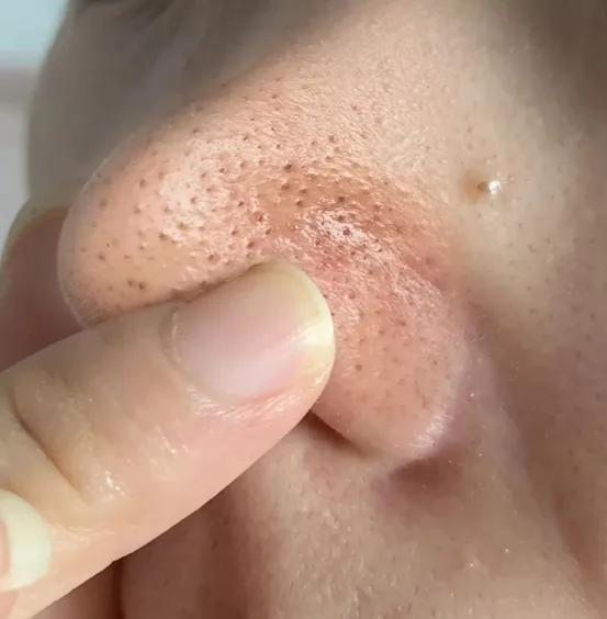 黑头毛孔粗大变细腻,皮肤黑头多毛孔大油脂分泌旺盛