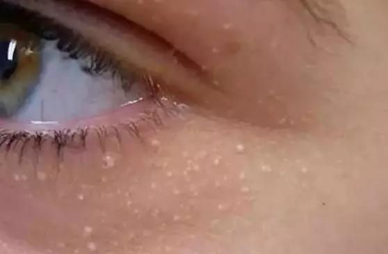 眼周脂肪粒可以激光去除吗,眼周脂肪粒会自动消失吗