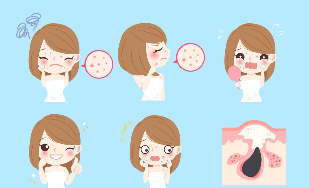 玫瑰*疮痤**患者机体免疫调节的异常，该病发病率呈现逐年上升的趋势