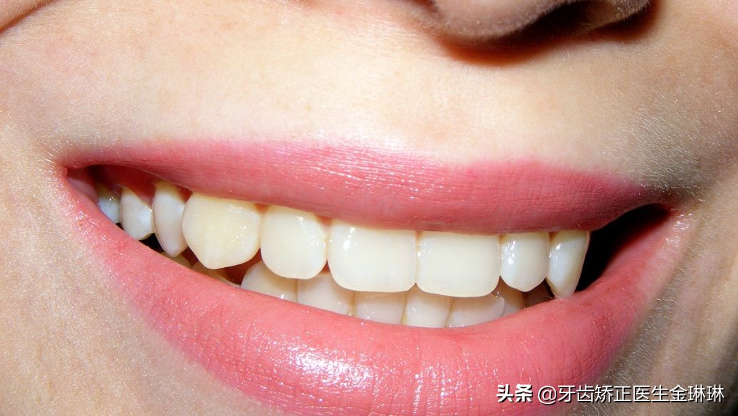 牙齿正畸前后变化大吗？带你看牙齿矫正变化图