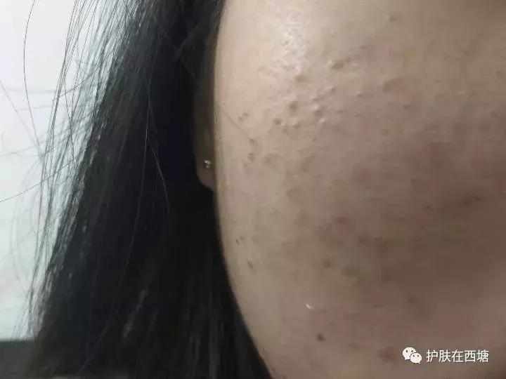 为什么额头上的痘痘反反复复,十几年的痘痘反反复复怎么办