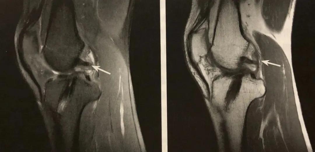膝关节常见损伤的检查方法,膝关节损伤病例图片
