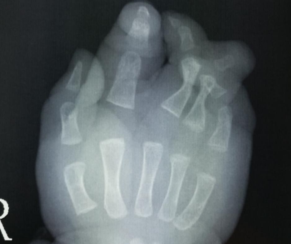 并指畸形免植皮案例,并指畸形