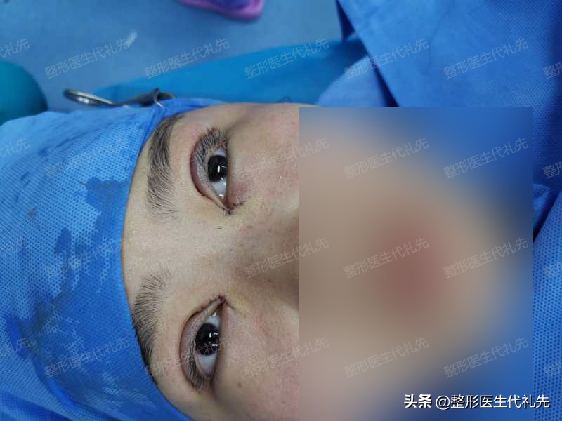 拯救肿泡眼做双眼皮的经历分享,肿眼泡做双眼皮恢复过程经历真实