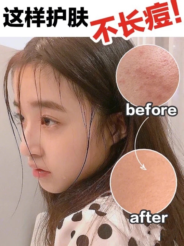 如何远离痘痘肌,远离痘痘的方法