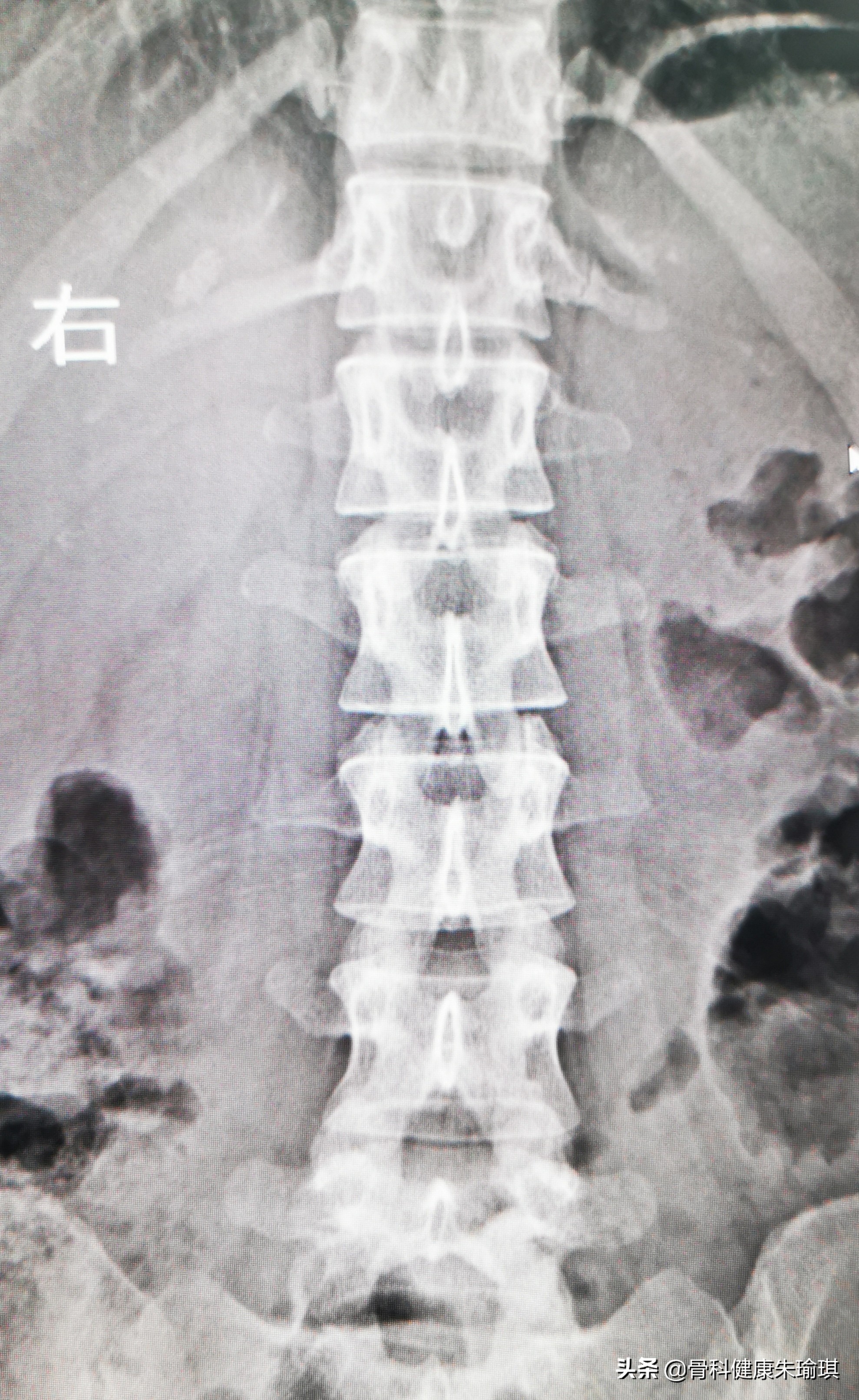 到底是横突骨折？还是正常的肋椎关节？