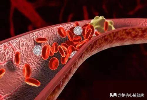 脑梗一年要打几次疏通血管的针,脑梗疏通血管最佳方法