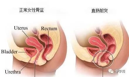 直肠前突便秘如何通便,直肠前突术后还是便秘怎么调理